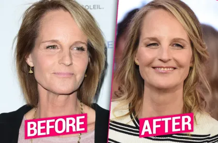 helen hunt plastic surgery images